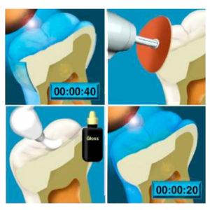 Vitremer estuche pequeño en color a3. Adquiere en Dentalmex Tienda Online