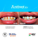 Antivent-Kit-de-mdc-dental