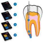 Propex-pixi-de-la-marca-Dentsply-Maillefer.-Deposito-Dental-Dentalmex